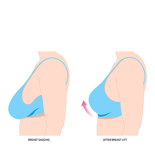 Breast Lift Surgery | Mastopexy | Specialist Plastic Surgeon Perth | West Coast Plastic Surgery