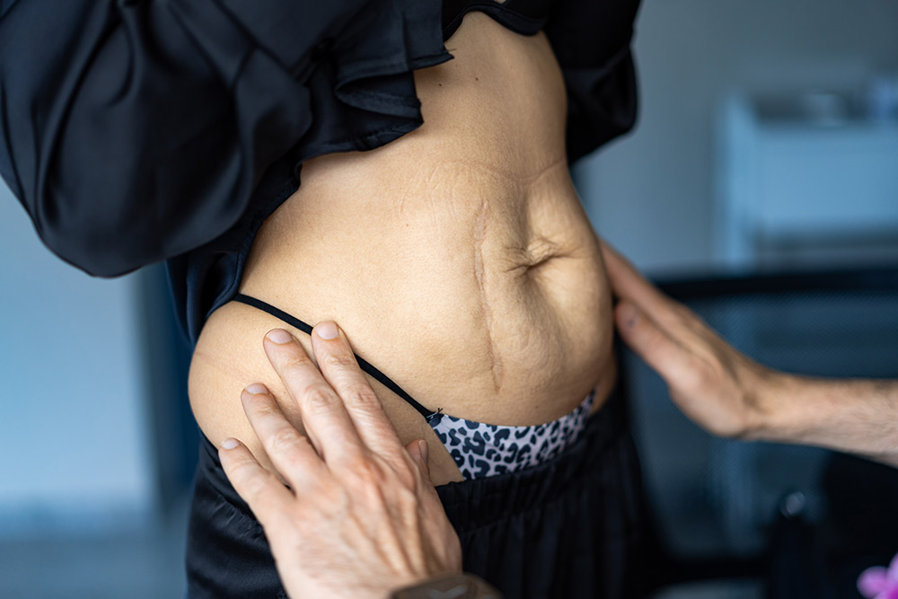 Tummy Tuck vs Liposuction | Difference Between Tummy Tuck and Liposuction | Abdominoplasty vs Liposuction