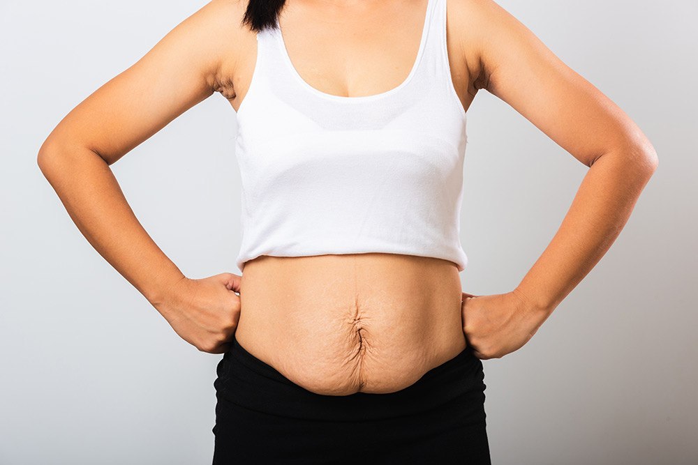 What is a Tummy Tuck | Tummy Tuck Candidates | Tummy Tuck Steps