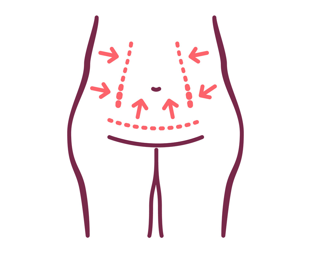 What is a Tummy Tuck | Tummy Tuck Candidates | Tummy Tuck Steps