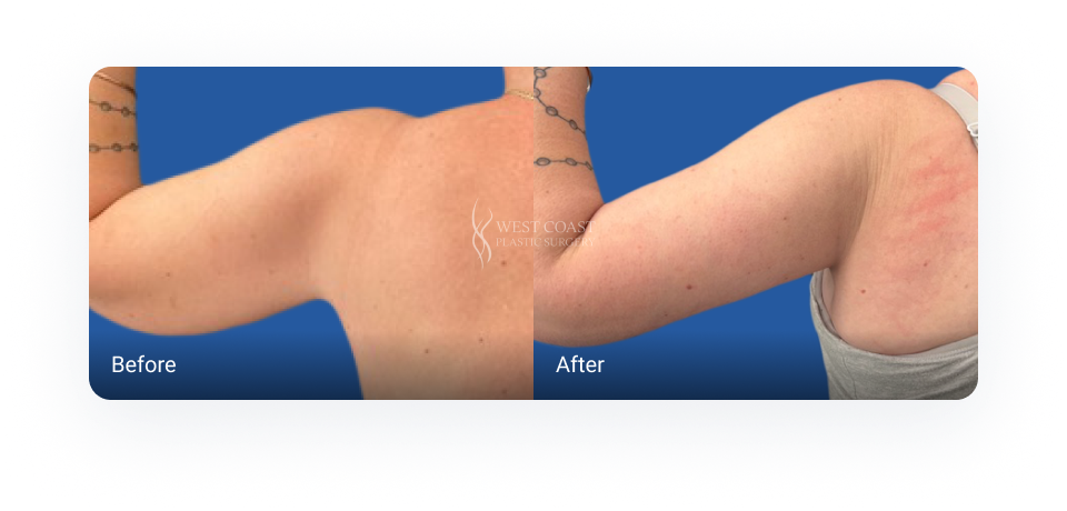 Before and after Arm Lift (Brachioplasty)