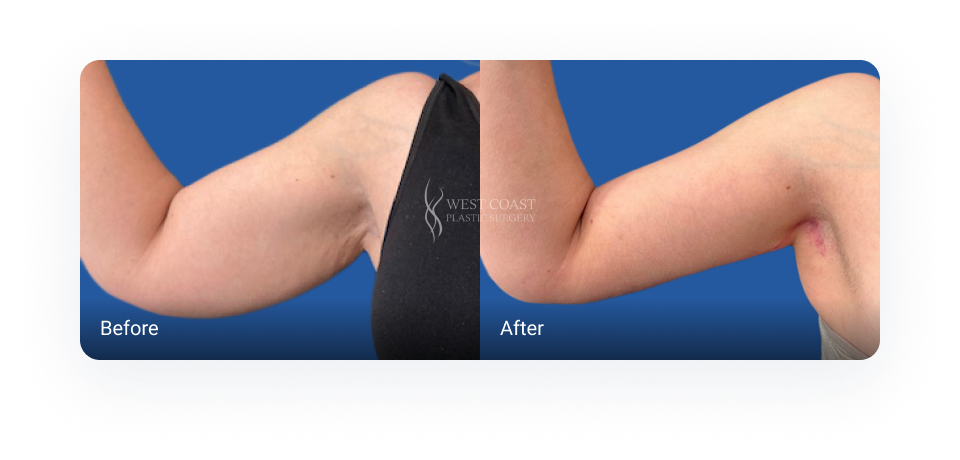 Before and after Arm Lift (Brachioplasty)