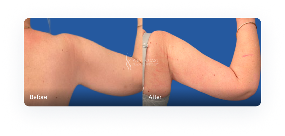 Before and after Arm Lift (Brachioplasty)