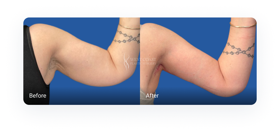 Before and after Arm Lift (Brachioplasty)