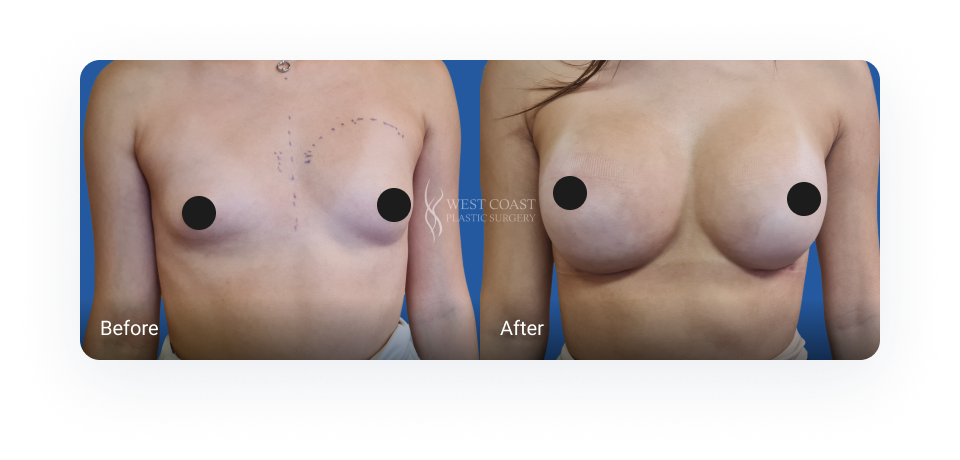 breast augmentation before and after