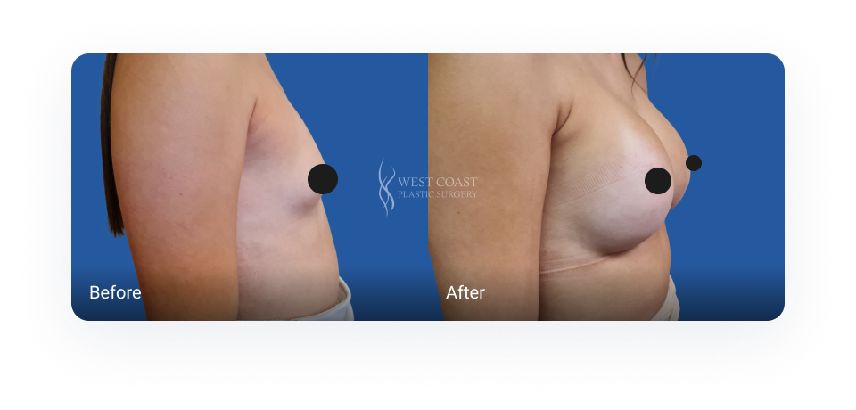 breast augmentation before and after