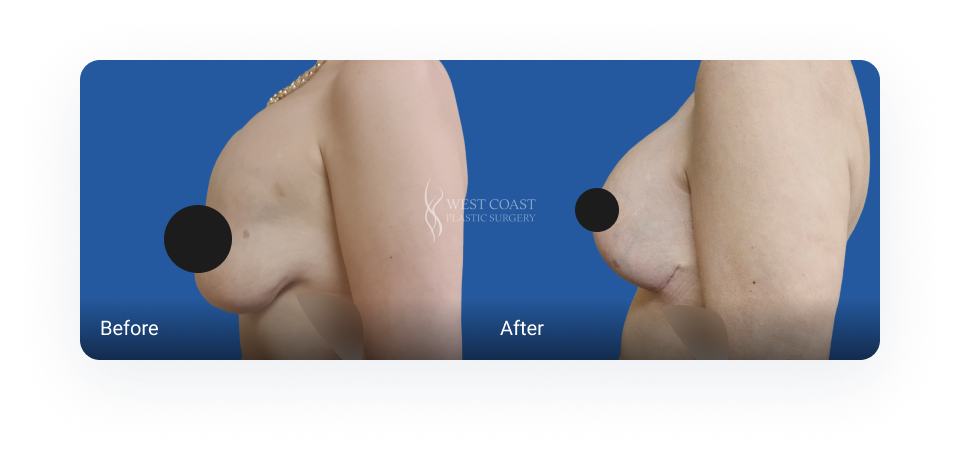 breast augmentation before and after