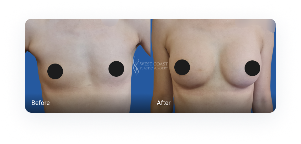 breast augmentation before and after