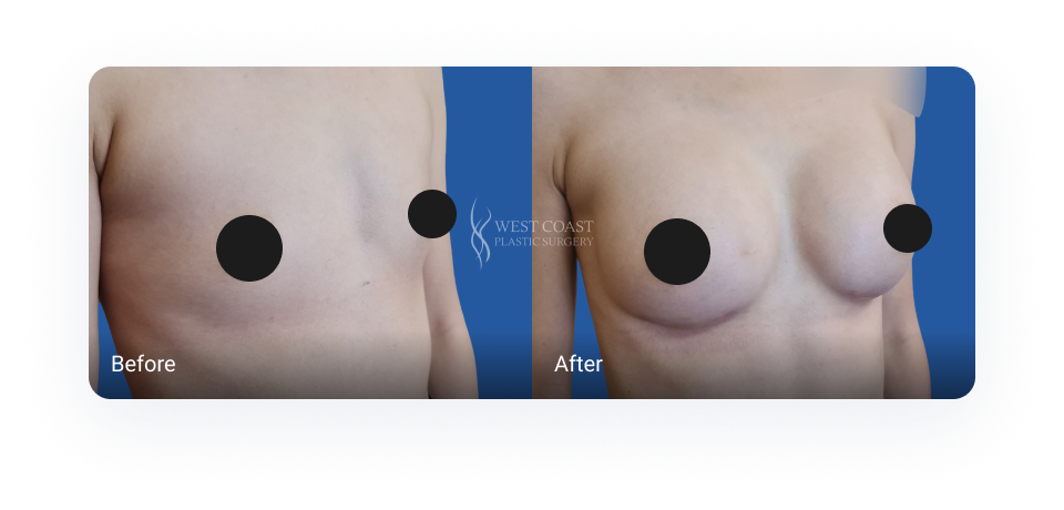 breast augmentation before and after