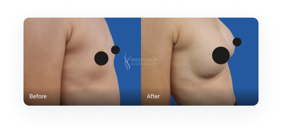 breast augmentation before and after