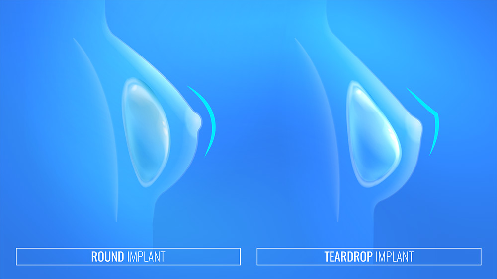 Round vs Teardrop Implants | Teardrop Breast Implants | Round vs Teardrop Implants Comparison