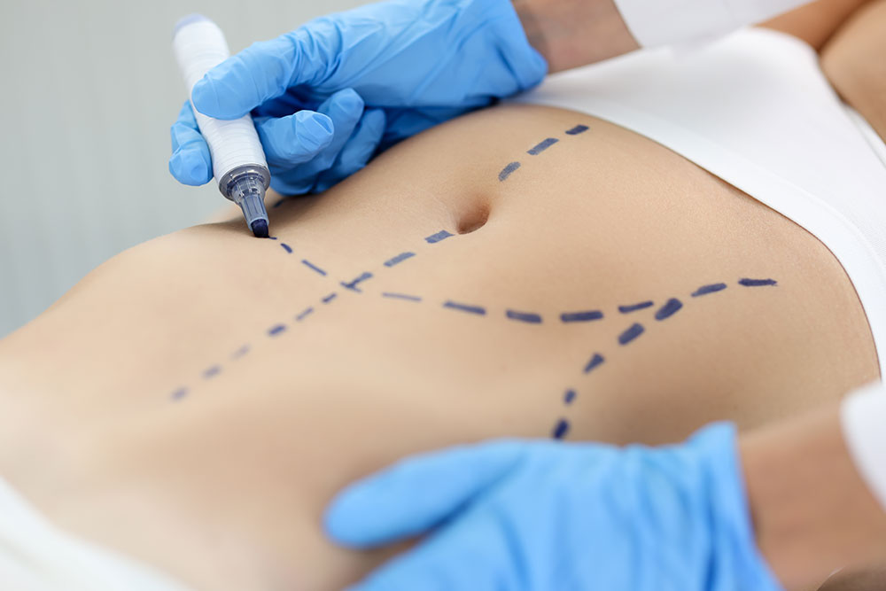 Mini Tummy Tuck vs Full Tummy Tuck | Mini Tummy Tuck Candidate | What is a Mini Tummy Tuck