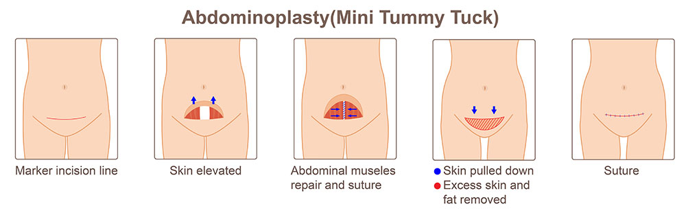 Mini Tummy Tuck vs Full Tummy Tuck | Mini Tummy Tuck Candidate | Difference Between Mini Tummy Tuck and Full