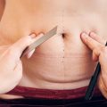 What is a Tummy Tuck | Tummy Tuck Candidates | Tummy Tuck Steps