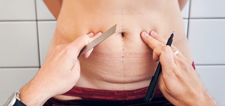 What is a Tummy Tuck | Tummy Tuck Candidates | Tummy Tuck Steps