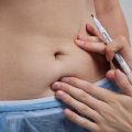 Mini Tummy Tuck vs Full Tummy Tuck | Mini Tummy Tuck Candidate | What is a Mini Tummy Tuck