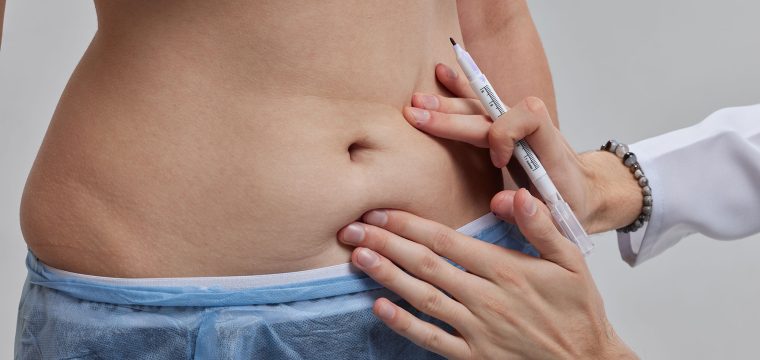 Mini Tummy Tuck vs Full Tummy Tuck | Mini Tummy Tuck Candidate | What is a Mini Tummy Tuck